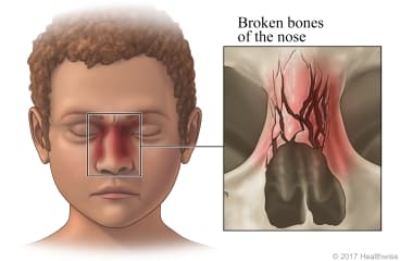 Child with broken nose, with inside view of broken nose bones