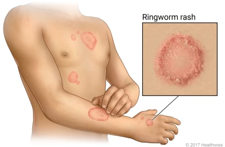 Ringworm skin rash on arm and chest, with a close-up of rash.