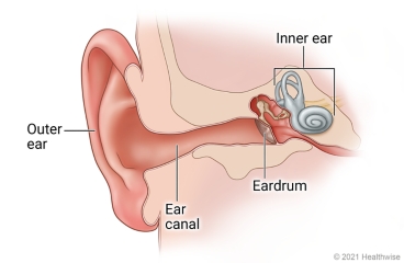 Otomycosis in Children: Care Instructions | Kaiser Permanente