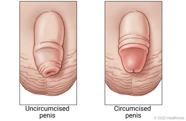 Uncircumcised penis with foreskin still in place and a circumcised penis with foreskin removed.