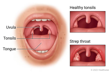 Open mouth showing throat, uvula, tonsils, and tongue, with detail of healthy tonsils and strep throat.