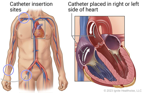 Catheter insertion points at neck, wrist, and groin, showing catheter placed in right side of heart or in left side.