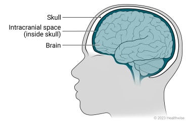 Side view of person's head, showing the skull surrounding the brain in the intracranial space.