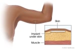 An example of where the birth control implant is inserted in under the skin.