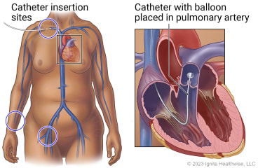 Body showing heart and catheter insertion sites at neck, groin and wrist, with detail of catheter placed in pulmonary artery with inflated balloon at end.