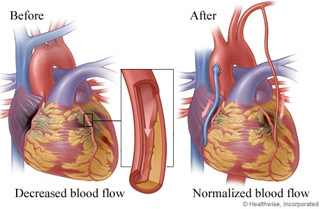 Decreased blood flow caused by narrowed or blocked artery before surgery and improved blood flow after surgery