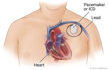 Location of pacemaker in upper-left chest, showing its lead through subclavian vein and into right ventricle