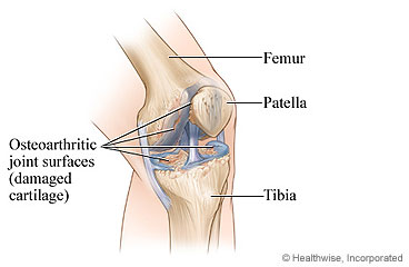Picture of a knee joint with osteoarthritis