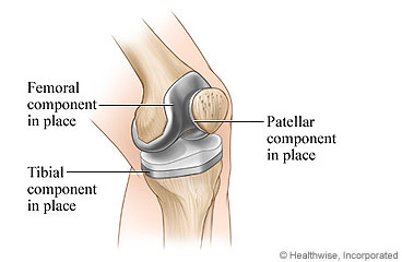 Knee structure after total knee replacement
