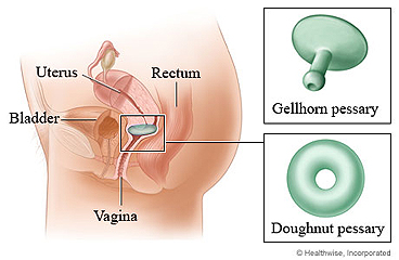 Gellhorn and doughnut pessaries, and an inserted doughnut pessary