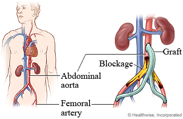 Abdominal and femoral arteries with detail of a blockage and a graft.