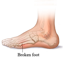 A broken foot