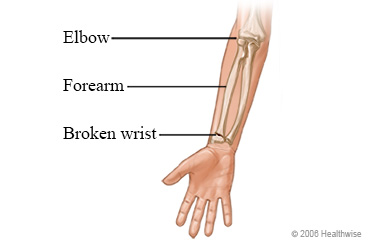 Arm bones and a broken wrist