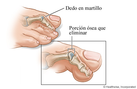 Dedo del pie en martillo y la sección ósea que se va a extraer