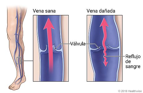Venas en la pierna, con detalle de vena y válvula sanas y de vena dañada que permite que algo de sangre fluya en sentido contrario.