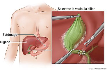 Posición de la vesícula biliar debajo del hígado, con detalle de los instrumentos quirúrgicos que se utilizan para extraer la vesícula biliar