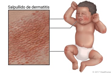 Bebé con eccema, donde se muestra salpullido en los codos, las mejillas y las rodillas.