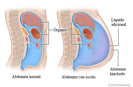 Corte transversal de órganos en el abdomen, que muestra abdomen normal y abdomen con exceso de líquido (ascitis)
