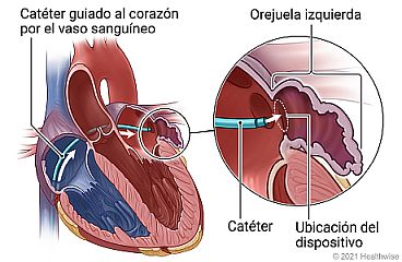 Vista interna del corazón con catéter guiado al corazón por el vaso sanguíneo, y detalle de la orejuela izquierda, catéter y ubicación del dispositivo.