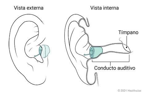 Vista externa e interna de audífono insertado completamente en el canal colocado en el oído.