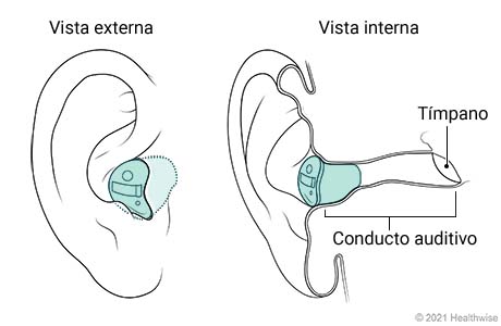 Vista externa e interna de audífono intracanal colocado en el oído.