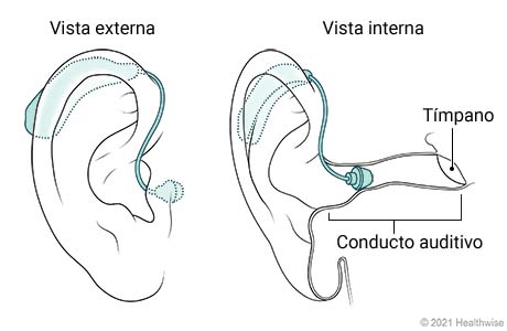 Vista externa e interna de un audífono miniatura retroauricular colocado en la oreja.
