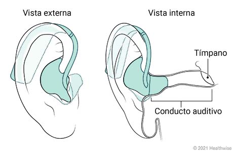 Vista externa e interna de audífono retroauricular colocado en la oreja.