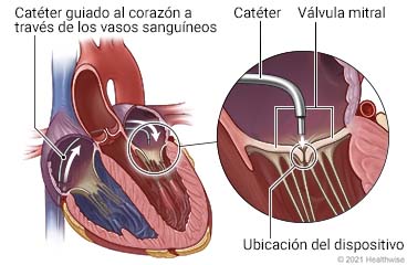 Vista interior del corazón que muestra la trayectoria del catéter a través del vaso sanguíneo, con detalles de la válvula mitral, el catéter y la ubicación del dispositivo en la válvula.