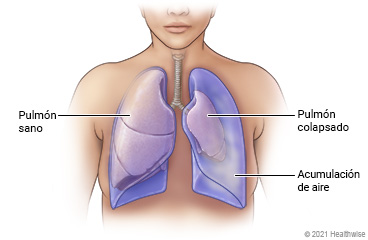 Pulmones en el pecho, donde se muestra un pulmón sano y un pulmón colapsado.