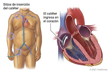 Ubicación de las zonas de inserción del catéter en el cuerpo, con detalle del catéter que ingresa al corazón.