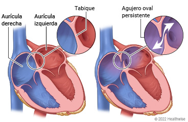 Vista interior de la aurícula derecha y la aurícula izquierda del corazón, con detalles que muestran un tabique normal y otro con agujero oval persistente.
