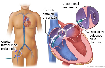 Catéter insertado en un vaso sanguíneo cerca de la ingle y en el corazón, con detalles que muestran el agujero oval persistente y el lugar donde se colocará el dispositivo.