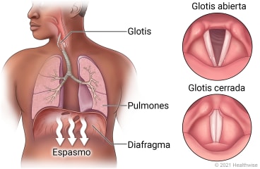Glotis en la garganta y pulmones en el tórax por encima del diafragma, mostrando el espasmo del diafragma que causa el hipo, con detalle de la glotis abierta y la glotis cerrada.