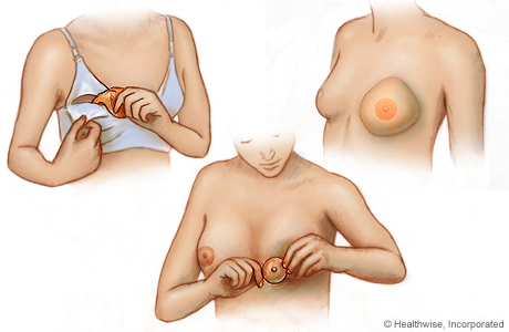 Tres tipos de prótesis mamarias