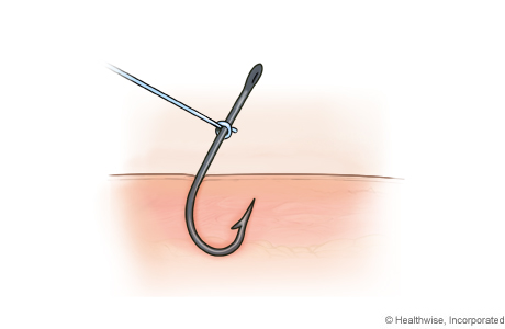 Método de tirar de un hilo para extraer un anzuelo, paso A: Ate un trozo de cuerda al anzuelo