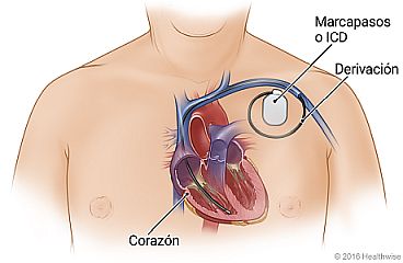Vista interna del corazón en el pecho, con ubicación de marcapasos o ICD en las proximidades y derivación del dispositivo a través del vaso sanguíneo al interior del corazón