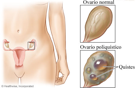 Ubicación de los ovarios con primer plano de un ovario normal y un ovario poliquístico