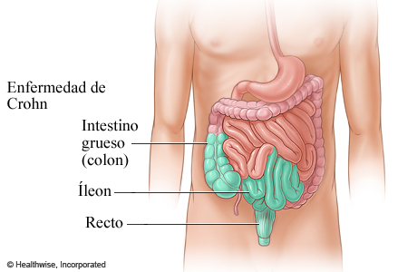Enfermedad de Crohn en parte del tubo digestivo.