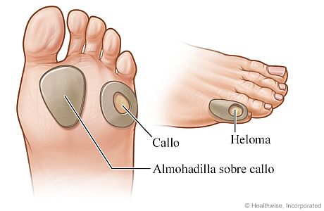 Almohadillas sobre heloma en dedo pequeño del pie y sobre callos en la planta del pie