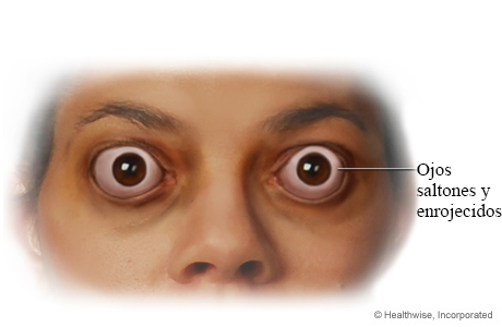 Ojos saltones causados por la enfermedad tiroidea