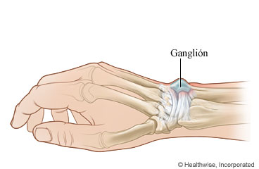 Ganglión (quiste ganglionar), con huesos y tendones de la muñeca