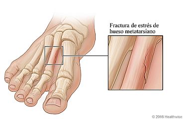 Vista de los huesos metatarsianos del pie