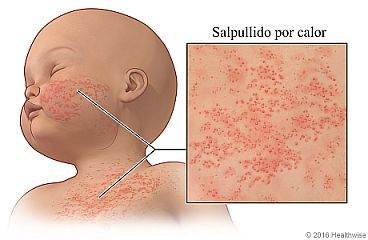 sarpullido por calor del bebé vs eczema