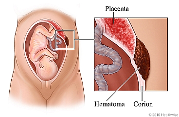 Un feto dentro del útero, con detalle de un hematoma subcoriónico