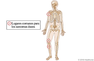 Lugares comunes para los sarcomas óseos, que incluyen encima y debajo de la rodilla y en la parte superior del brazo