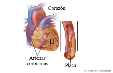 Enfermedad de las arterias coronarias