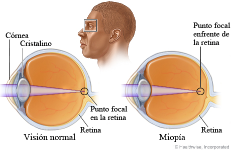 ¿Qué causa la miopía?