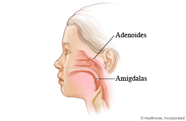 Ubicación de las adenoides y las amígdalas