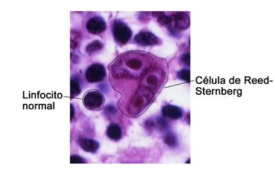 Célula de Reed-Sternberg. En la fotografía se observan linfocitos normales y se los compara con una célula de Reed-Sternberg.