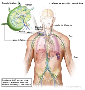 Linfoma en estadio I en adultos. En el dibujo se observa cáncer en 1 grupo de ganglios linfáticos cerca del cuello y en el bazo. También se muestra el anillo de Waldeyer y el timo. En una ampliación, se muestran un ganglio linfático con células cancerosas, un vaso linfático, una arteria y una vena.